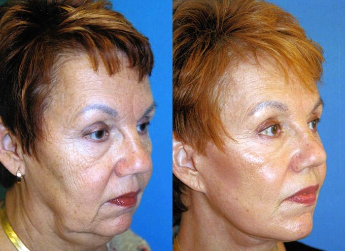 Facelift Photos Melbourne, FL Patient 27962